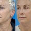 Facelift and Neck Lift in Turkey: Restore Youthful, Natural-Looking Results