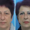 Eyelid Surgery in Turkey: Restore a Youthful and Refreshed Look
