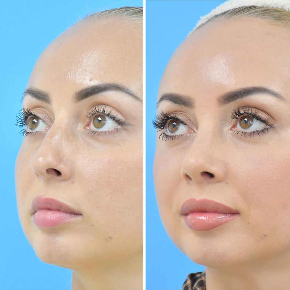 Rhinoplasty Revision