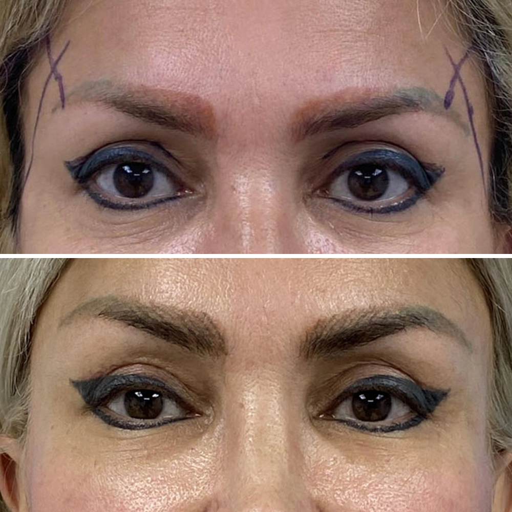 Eyelid Surgery