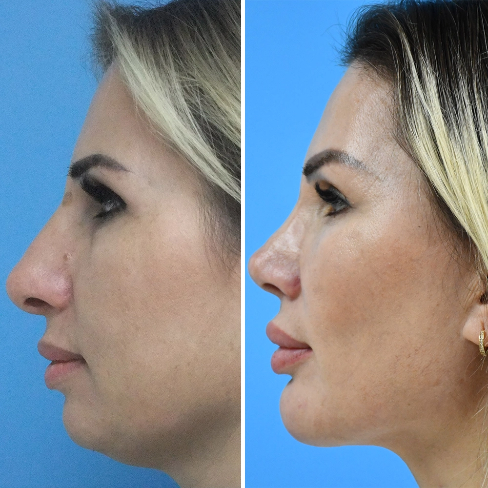 Rhinoplasty Patient