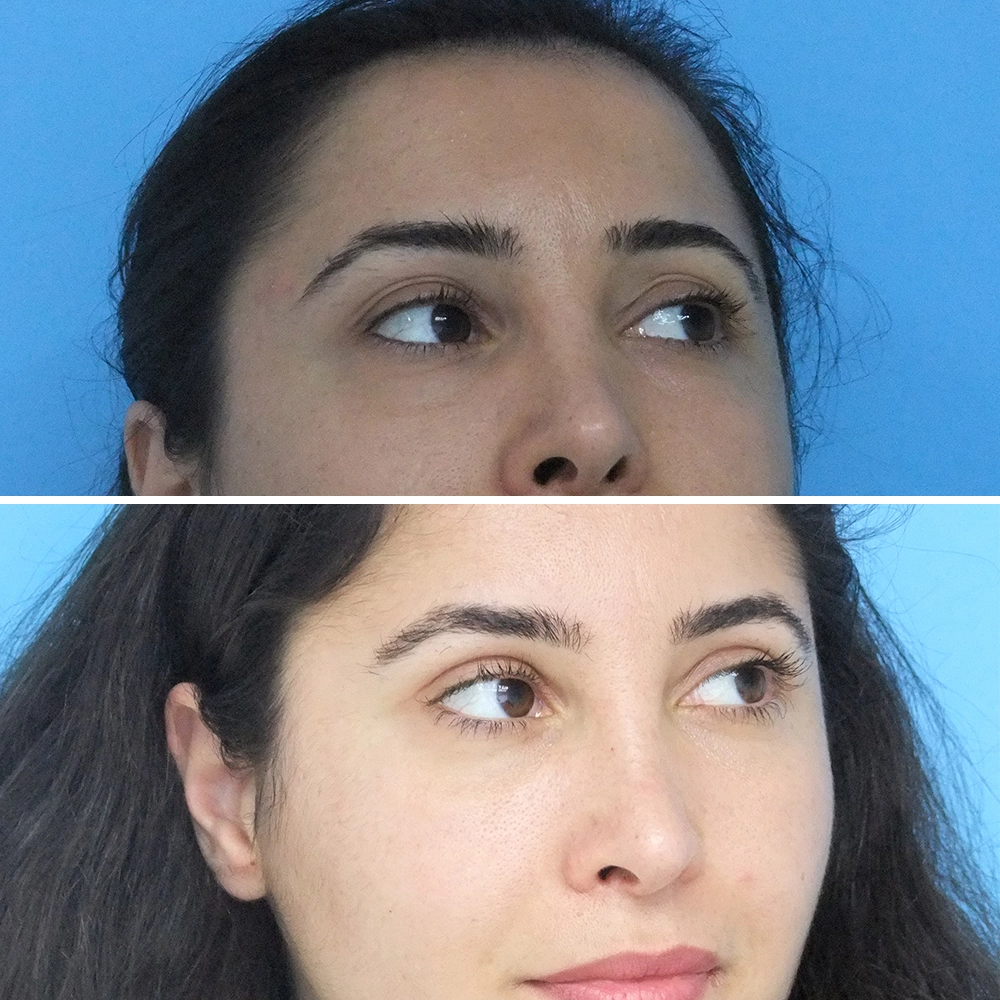 Blepharoplasty Patient