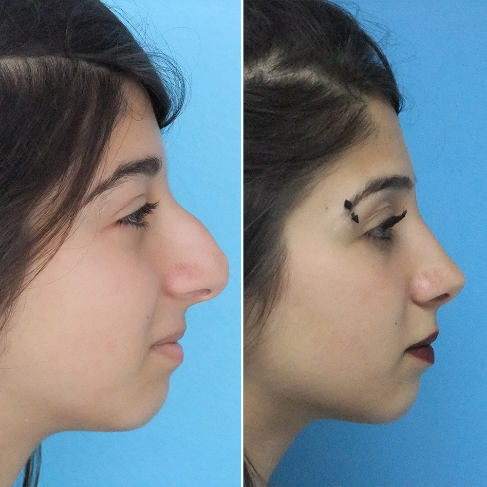 Rhinoplasty