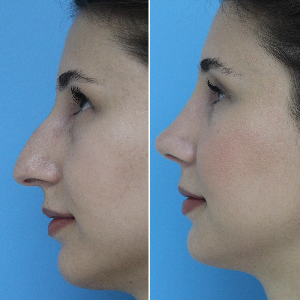 Rhinoplasty