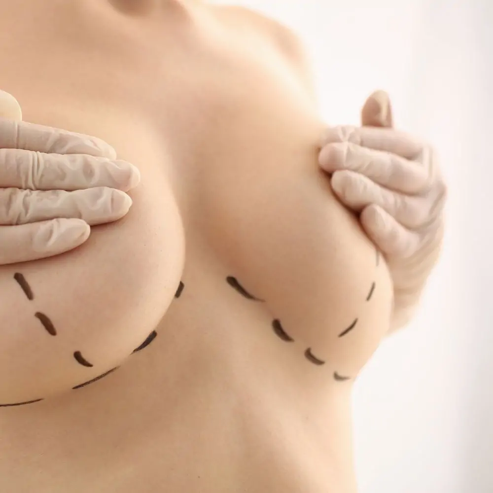 Breast Lift Surgery