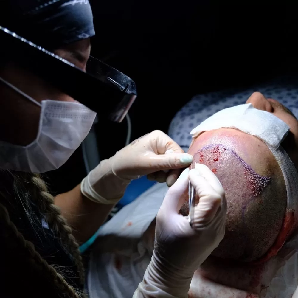 Sapphire FUE Hair Transplant