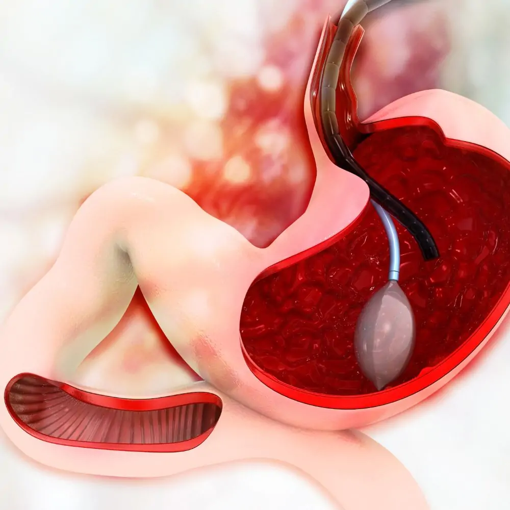 Gastric Balloon Surgery