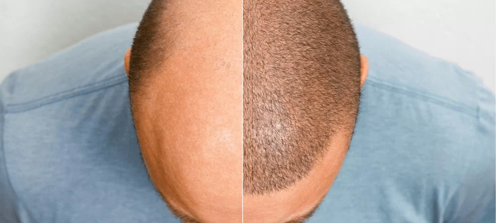 Hair Transplantation