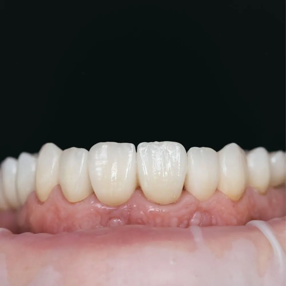 Zirconium Crowns